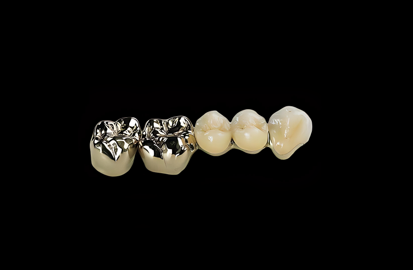 PFM Semi-Precious